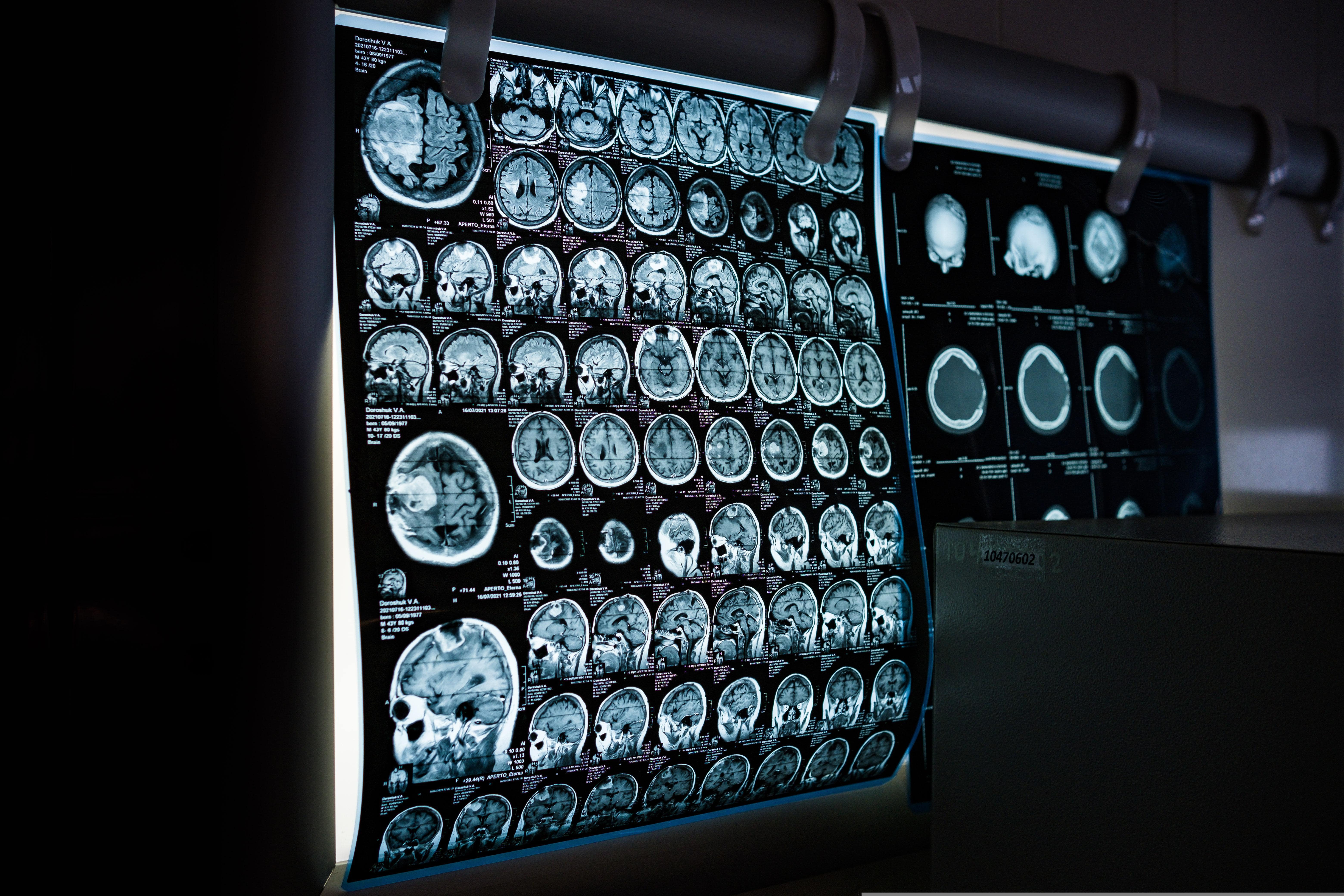 Development of an Artificial Intelligence System for Phenotyping of Patients with Acute Stroke